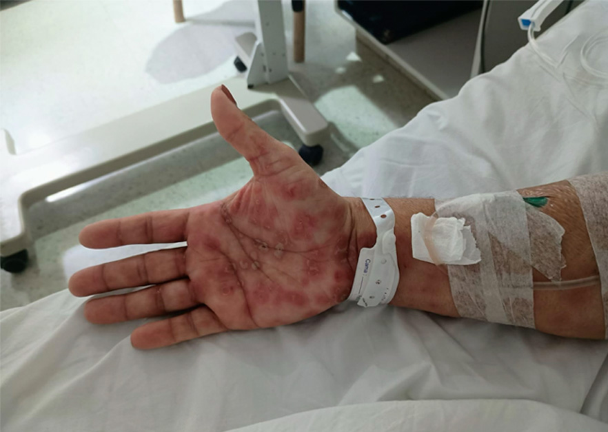 Imagen del caso Exantema en paciente con Artritis Reumatoidea 