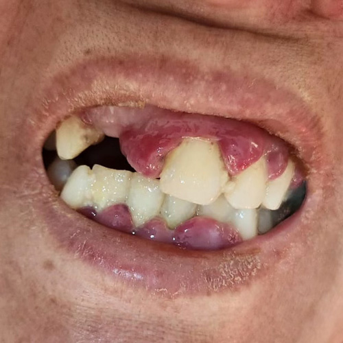 Imagen del caso Mujer de 45 años con anemia y hematomas espontáneos.